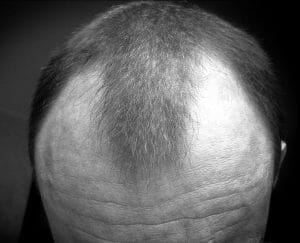 alopecia androgénica