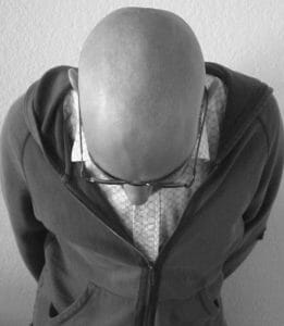 alopecia