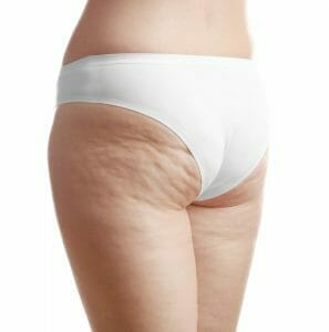 muslos y nalgas donde la celulitis es visible