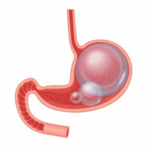 gráfico de estómago e intestinos hinchados