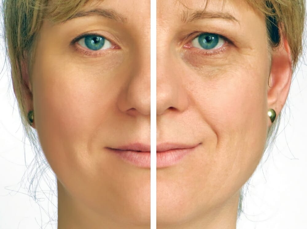 arrugas faciales